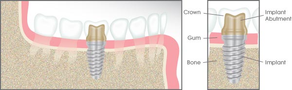 dental-implants